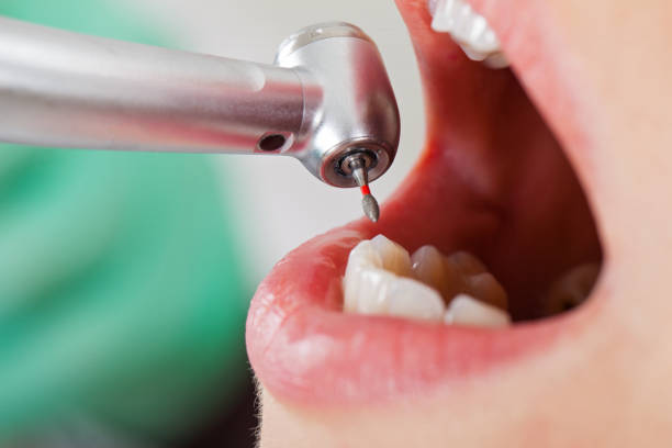 Best Emergency Broken Tooth Repair in Culver, IN